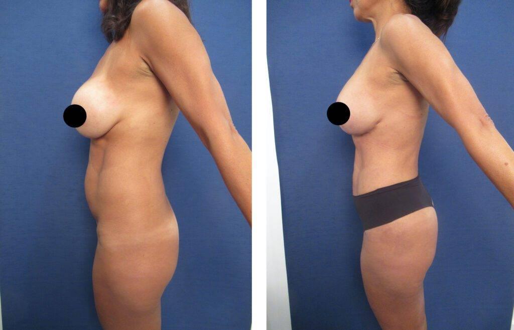 Discover the amazing transformation of a tummy tuck before and after the procedure, including insights on whether a mini tummy tuck can lower the belly button.