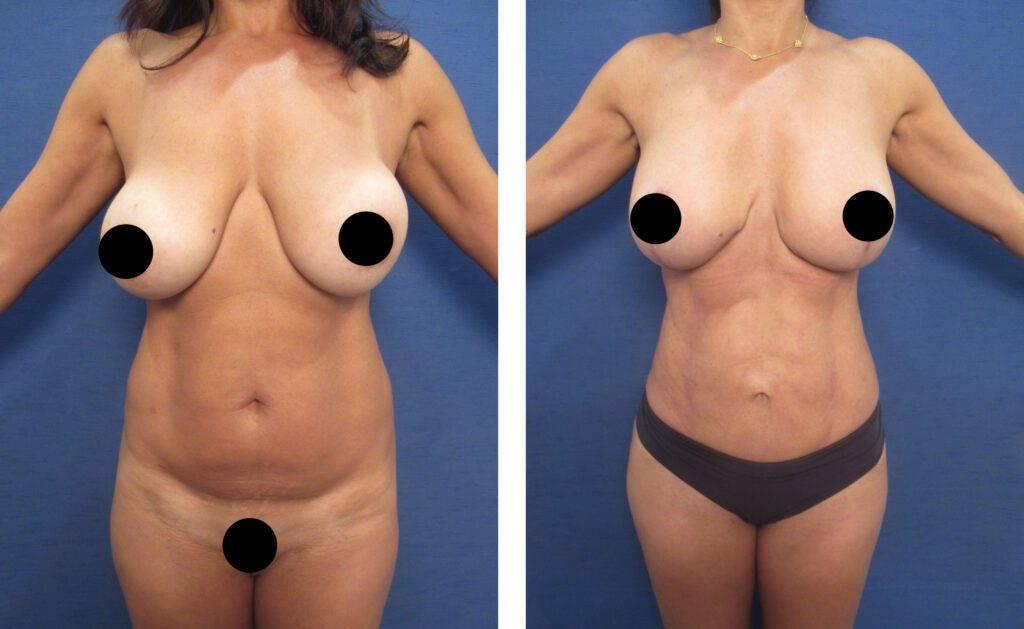 Does mini tummy tuck lower the belly button? See the impressive before and after photos.