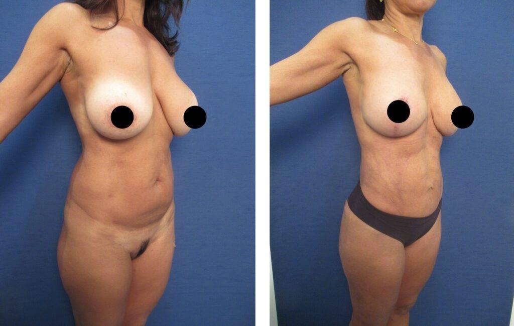 The transformation of a woman's breasts after breast augmentation is remarkable, giving her enhanced curves and improved self-confidence.