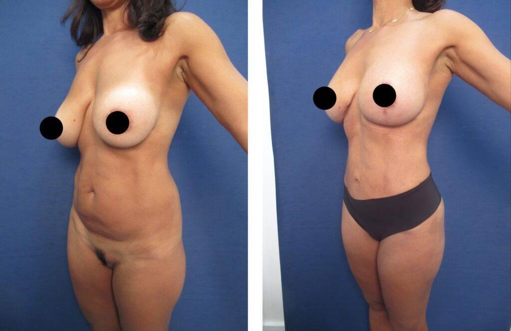 The transformation of a woman's breasts before and after breast augmentation.