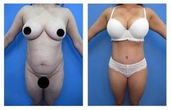 Tummy tuck before and after: Everything you need to know about the surgery.
