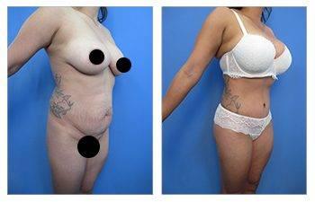 Everything you need to know about tummy tuck surgery: before and after.