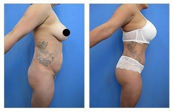 Tummy tuck before and after: everything you need to know.