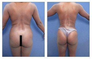 Fat Embolism: What is it and how to avoid?