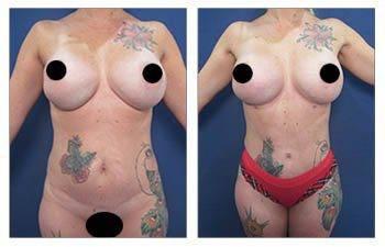 A woman with tattoos before and after breast surgery, showcasing the transformation and discussing the fat transfer cost.