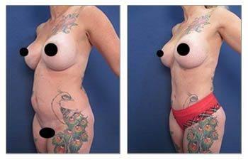 Tummy tuck before and after with information on Fat Transfer Cost.