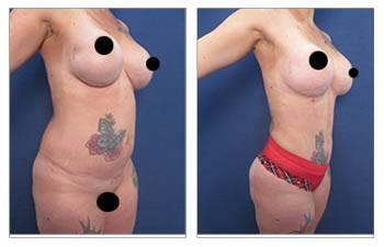 Explore the remarkable tummy tuck before and after transformations and discover the fat transfer cost options.