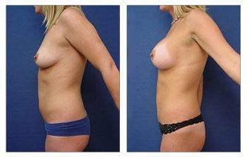 Breast augmentation with fat transfer