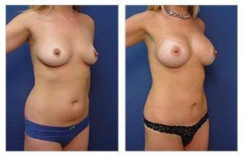 Fat Transfer Prices
