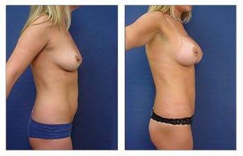 Fat Transfer Prices