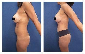GMommy Breast Lift