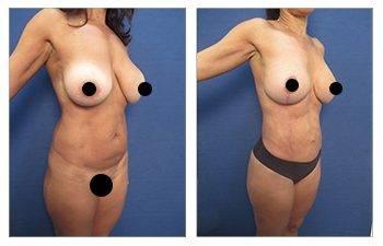 GMommy Breast Lift
