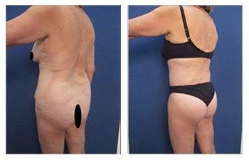 Maximizing Buttock Augmentation — patient photo