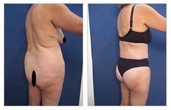 360 Liposuction or Liposuction area-by-area - Which One is Better? — patient photo