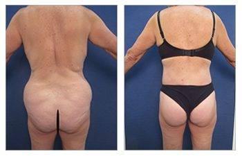 Staged body contouring - see tummy tuck before and after transformations.