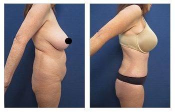 Who Does the Most VASER Liposuction Surgeries