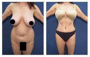 Mini Tummy Tucks in Beverly Hills - See the incredible before and after results!