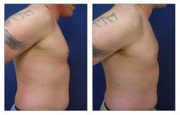 Gynecomastia