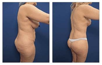 Check out the incredible tummy tuck before and after transformations.