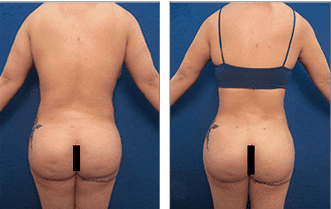 HD Liposuction 360