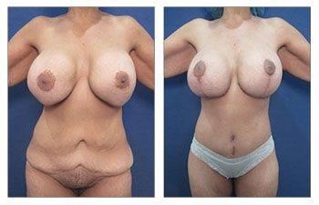 High Definition Body Contouring