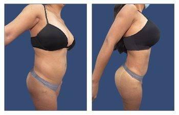 Waist Contouring + Mini Tummy Tuck — #SS028