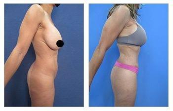 High Definition Liposuction Gender Specific Differences