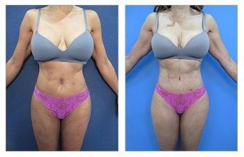 High Definition Liposuction Gender Specific Differences