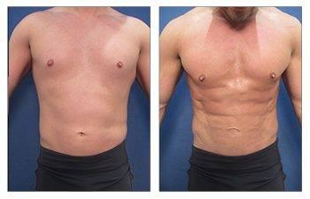 Best male tummy tuck before and after results.