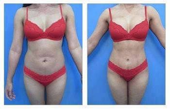 Mommy makeover for plus sized clients