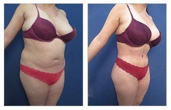 Staged body contouring - see tummy tuck before and after transformations.