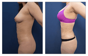 High Definition Mini Tummy Tuck before and after.