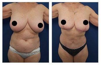 Scarless Skin Tightening with Renuvion — patient photo
