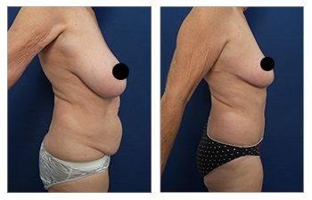 Learn about the Mini Tummy Tuck procedure and see stunning before and after photos.