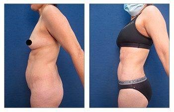 High Definition Tummy Tuck High Definition Tummy Tuck