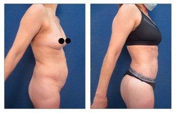 High Definition Tummy Tuck High Definition Tummy Tuck