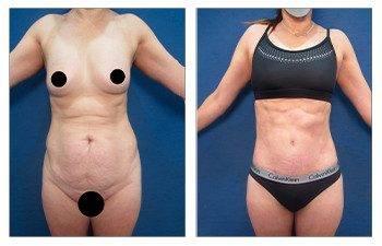 High Definition Tummy Tuck High Definition Tummy Tuck