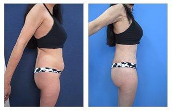 Hip Dip Surgery