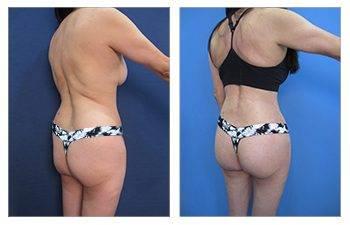 Hip Dip Surgery