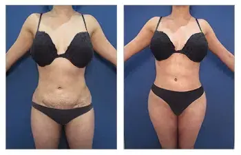 How Can I Have Painless 360 Lipo?