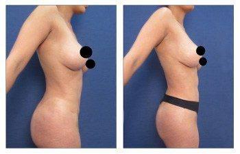 Painless Lipo