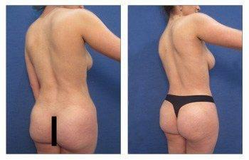 Painless Lipo