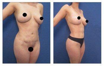Painless Lipo