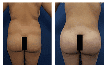 how common are buttock implants