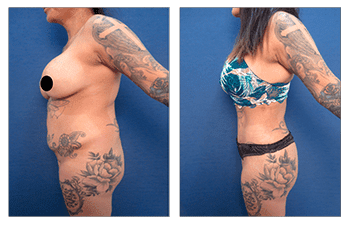 How Does VASER Melt the Fat?
