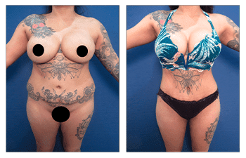 How Does VASER Melt the Fat?