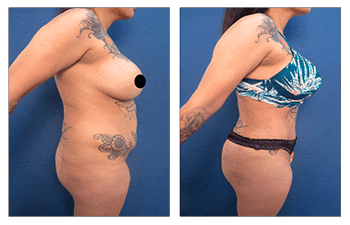 How Does VASER Melt the Fat?