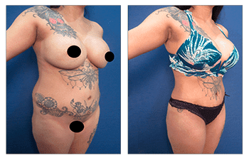 How Does VASER Melt the Fat?