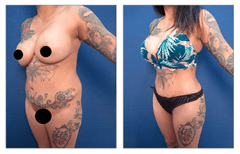 How Does VASER Melt the Fat?