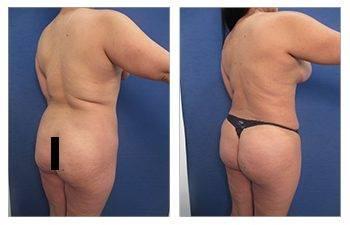 A woman's butt before and after a Mini Mommy Makeover, which includes a tummy tuck.